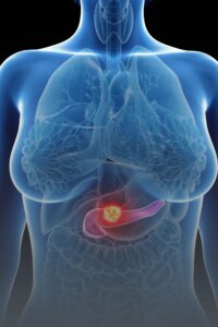 pankreas kanseri whipple ameliyatı