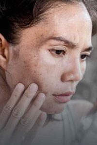 leke, leke tedavisi, peeling, dermatoloji, 