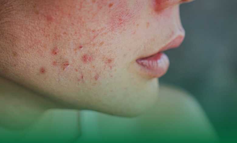 akne, tedavi, sağlık
