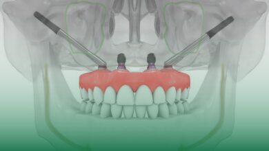 zigomatik implant, implant, üst çene kemiği