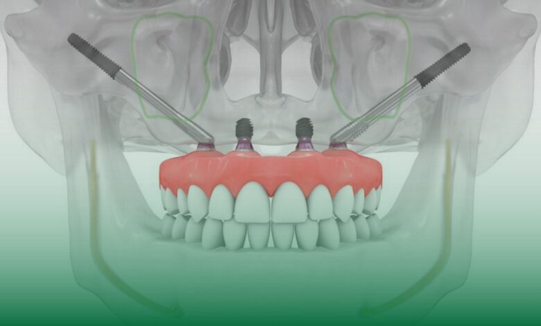 zigomatik implant, implant, üst çene kemiği