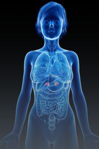 cushing, böbrek üstü, kadın, hastalık, 