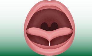 konuşma bozukluğu, dil bağı,