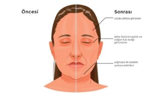 zayıflama iğnesi, ozempic face