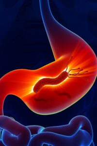 helicobacter pylori, gastroenteroloji uzmanı zülfikar polat