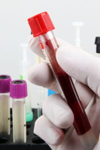 alzheimer, kan testi