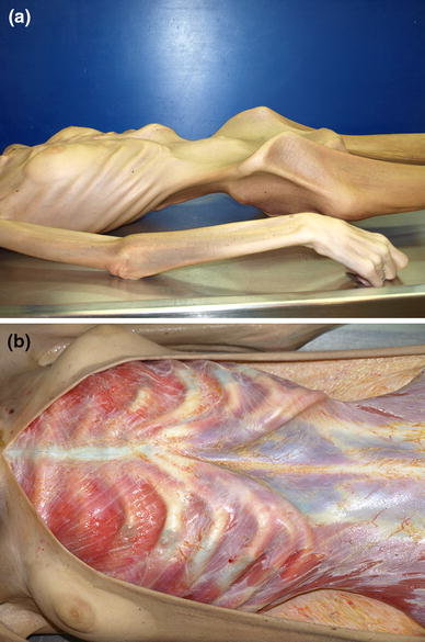 anoreksiya, nihal candan, ölümcül, açlık,