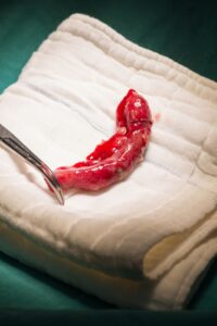 apandis, apandisit, kanser, 