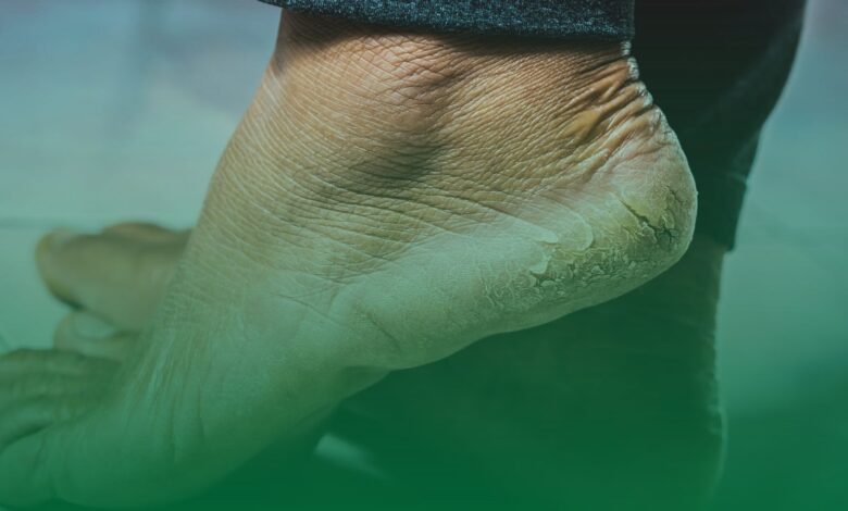 ayakkabı seçimi, nasır, ayak sağlığı,