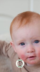 inek sütü alerjisi,