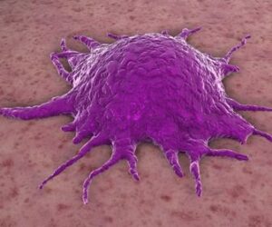 meme kanserinde dondurarak tedavi, kriyoablasyon, kriyoterapi, cem yılmaz, memede kanser, 