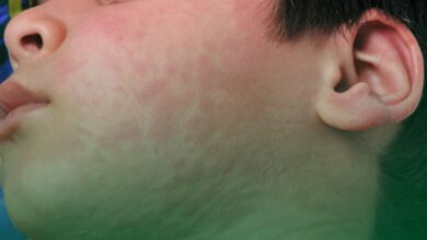 ürtiker, kabarıklık, yüz,