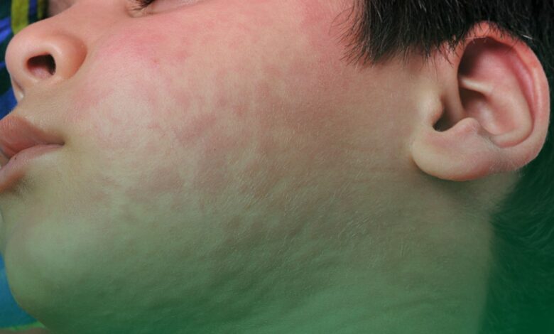 ürtiker, kabarıklık, yüz,