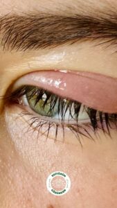 göz, şişlik, ürtiker,