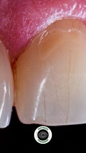 diş taşı, diş eti çekilmesi,