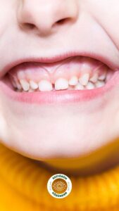 diş sağlığı, çocuk,