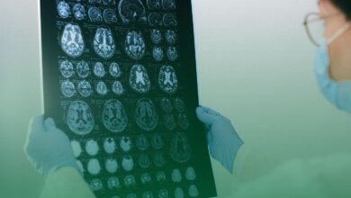 Alzheimer, tedavi, tps,