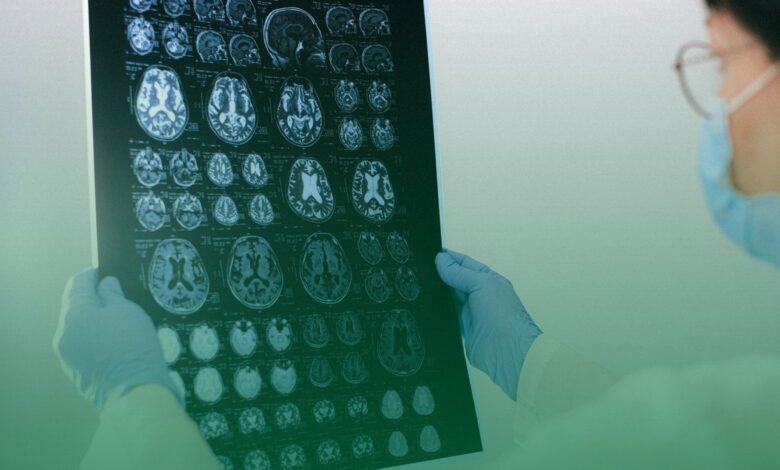 Alzheimer, tedavi, tps,