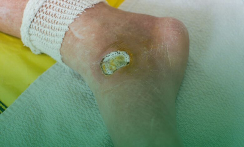 ayak yarası, diyabet,