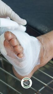 diyabet, ayak yarası,