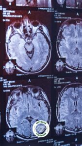 demans, akdeniz diyeti, risk,