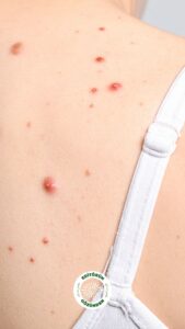 agresif melanom, mrna, aşı,