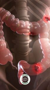 inflamatuar bağırsak hastalığı