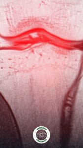 diz ağrısı, menisküs yırtığı,