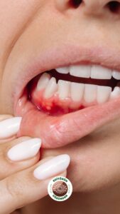 diş, fırça, kanama,