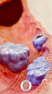 kolon kanseri, gençlik,