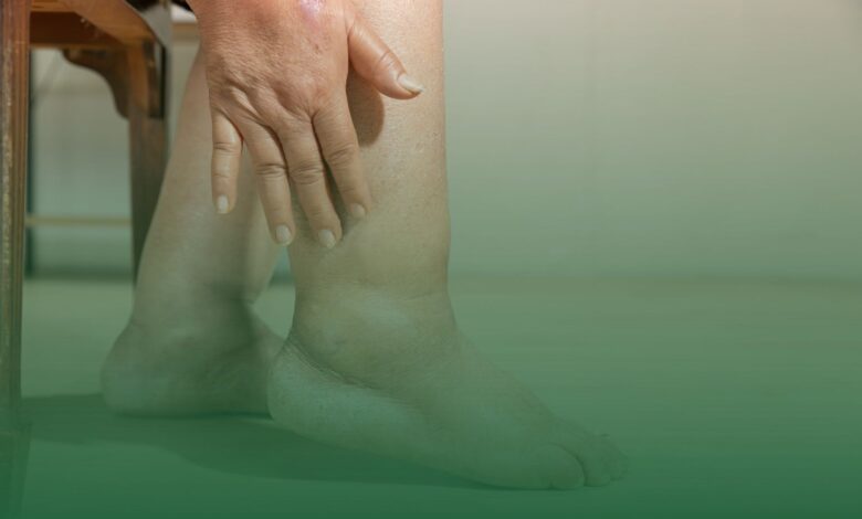 Bacakta Şişlik