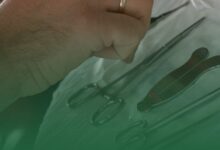 kadın sünneti, hud derisi alma, genital estetik