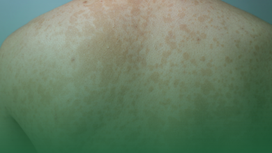 tinea versikolor, vücut mantarı,