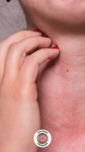 histamin